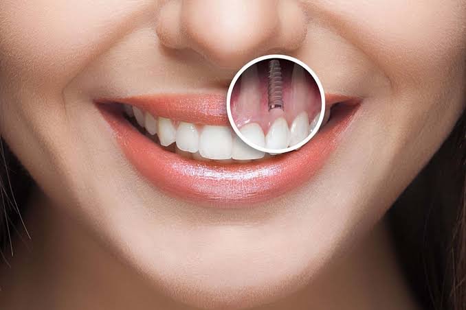 Alanya Dental İmplant Tedavisi